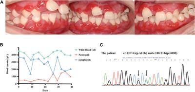 Case report: Five-year periodontal management of a patient with two novel mutation sites in ELANE-induced cyclic neutropenia